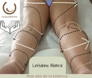 Drenaje Linfático Manual en "LINFEDEMA" Miembros Inferiores.
